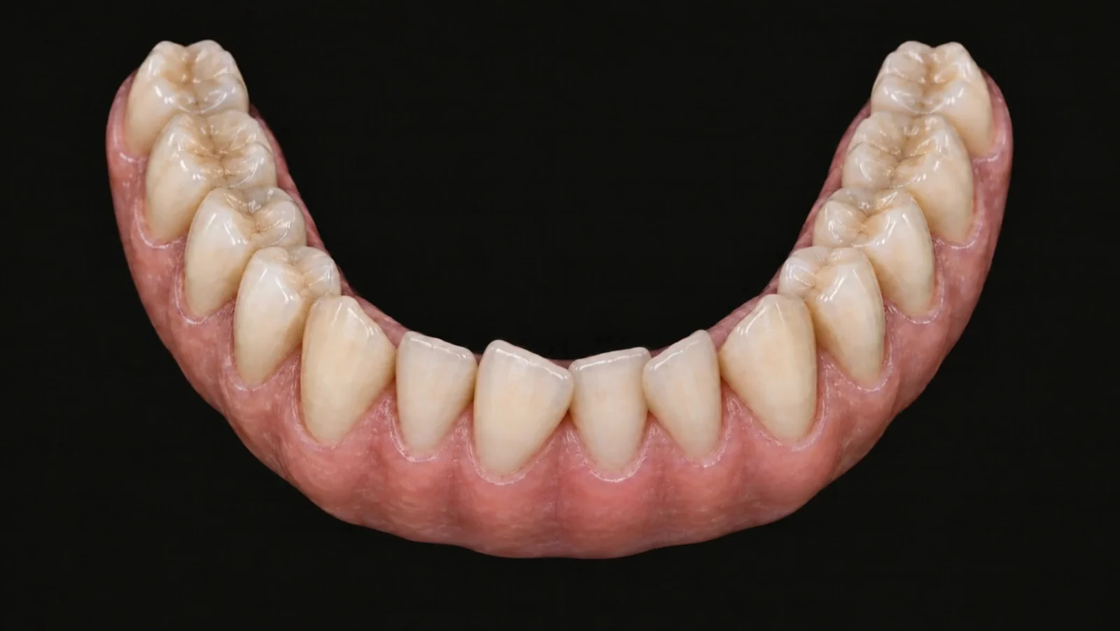 AI-generated lower jaw model with crowded lower front teeth before schematic tooth movement