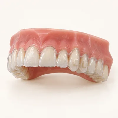 Teaching illustration: Aligner attachment