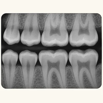 Teaching illustration: Bitewing X-ray