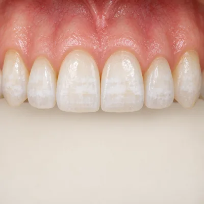 Teaching illustration: Dental fluorosis