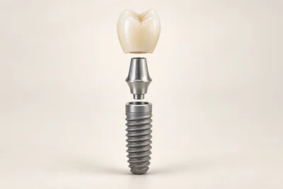 Teaching illustration: Implant abutment