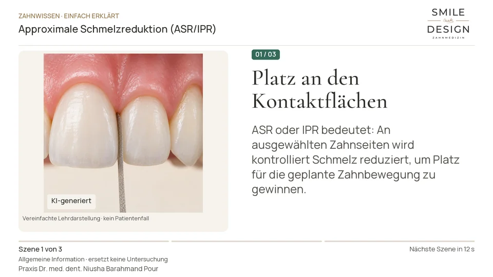 Kurzfilm: Warum wird zwischen Zähnen manchmal Schmelz reduziert?