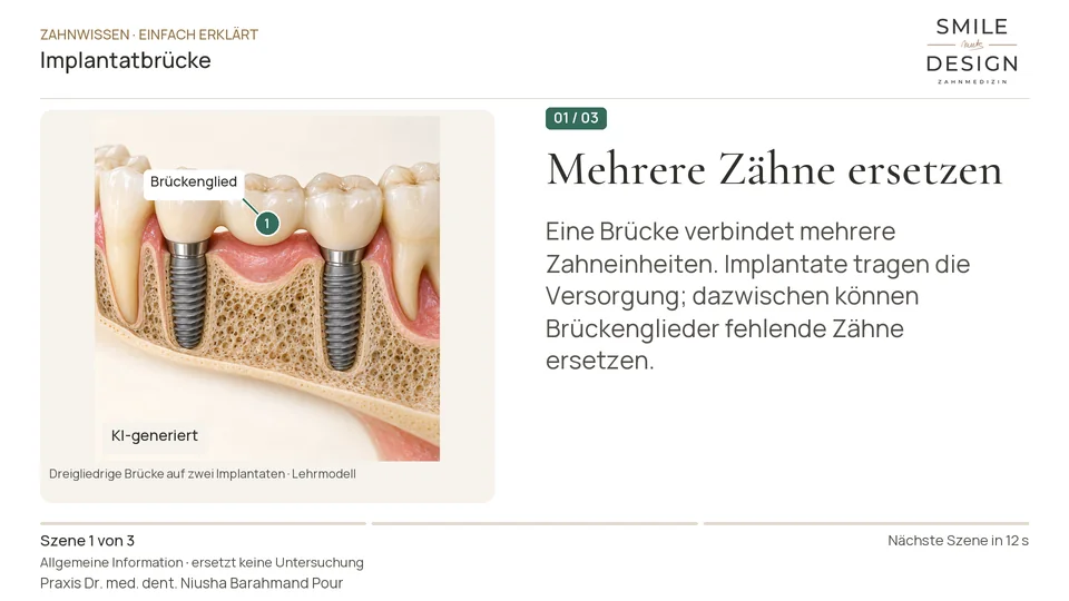 Kurzfilm: Braucht jeder fehlende Zahn ein eigenes Implantat?
