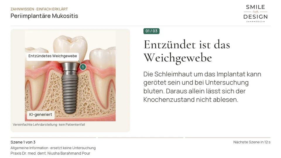 Kurzfilm: Was ist eine Zahnfleischentzündung am Implantat?