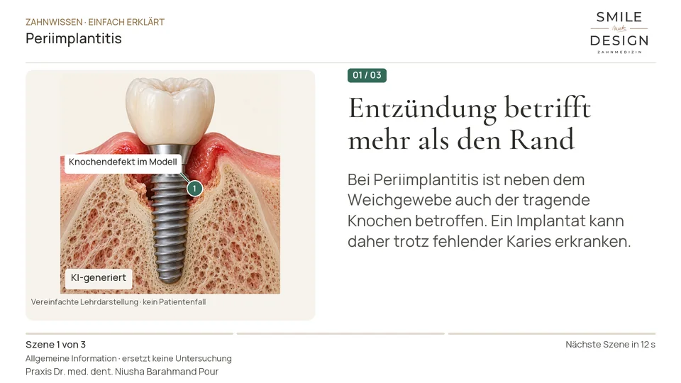 Kurzfilm: Kann sich auch Gewebe um ein Implantat entzünden?