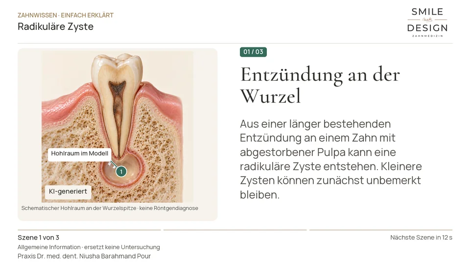 Kurzfilm: Was ist eine Zyste an der Zahnwurzel?