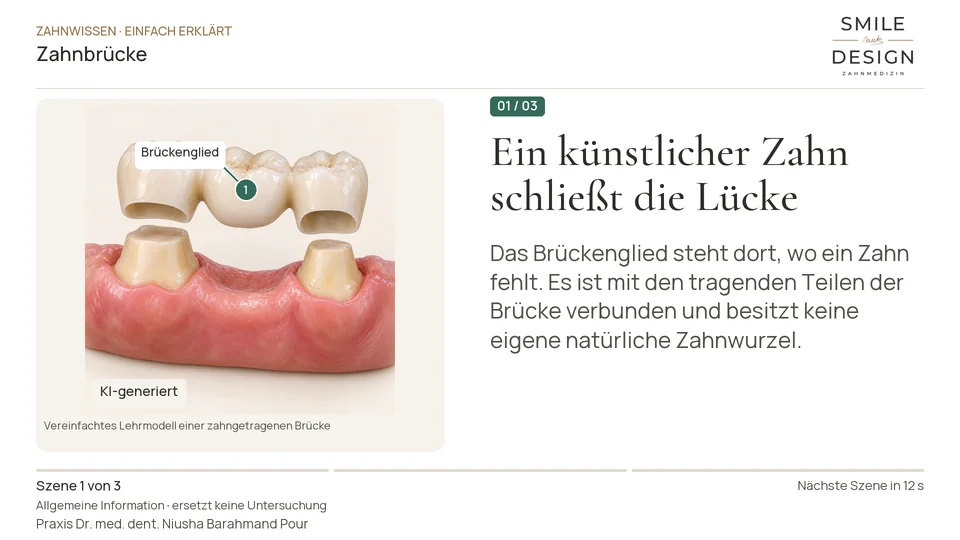 Kurzfilm: Wie trägt eine Brücke einen fehlenden Zahn?
