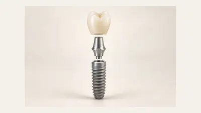 Illustration: Implantate verstehen.