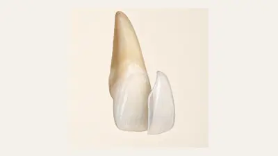 Illustration: Veneers verstehen.