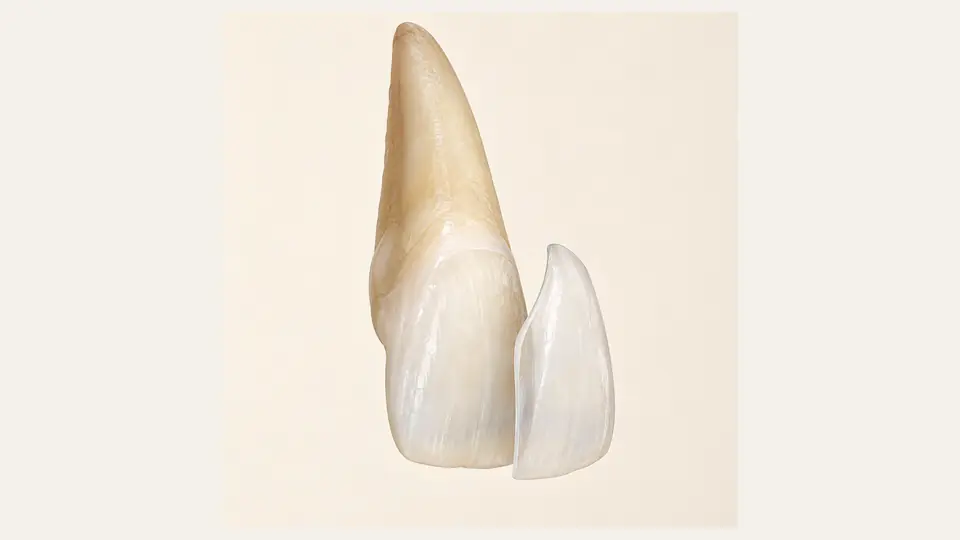 Illustration: Veneers verstehen.